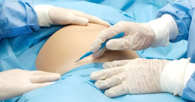 Кесарево сечение – как проходит операция, и как восстановиться после родов?