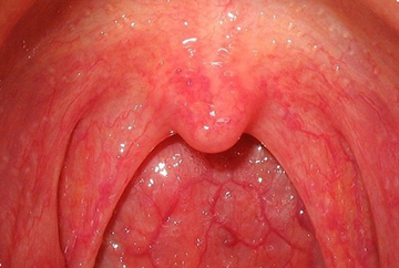 горло при катаральной ангине